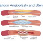 PAD treatment balloon angioplasty and stents diagram