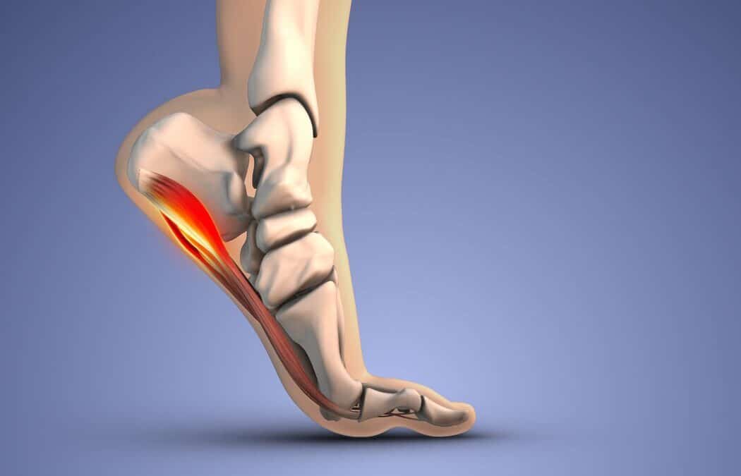 Is Plantar Fasciitis Embolization (PFE) Right for You?