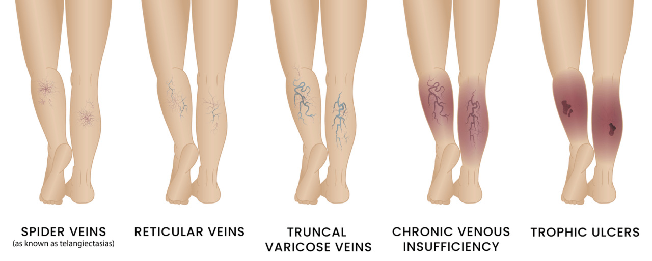 Varicose Veins | New England Endovascular Center