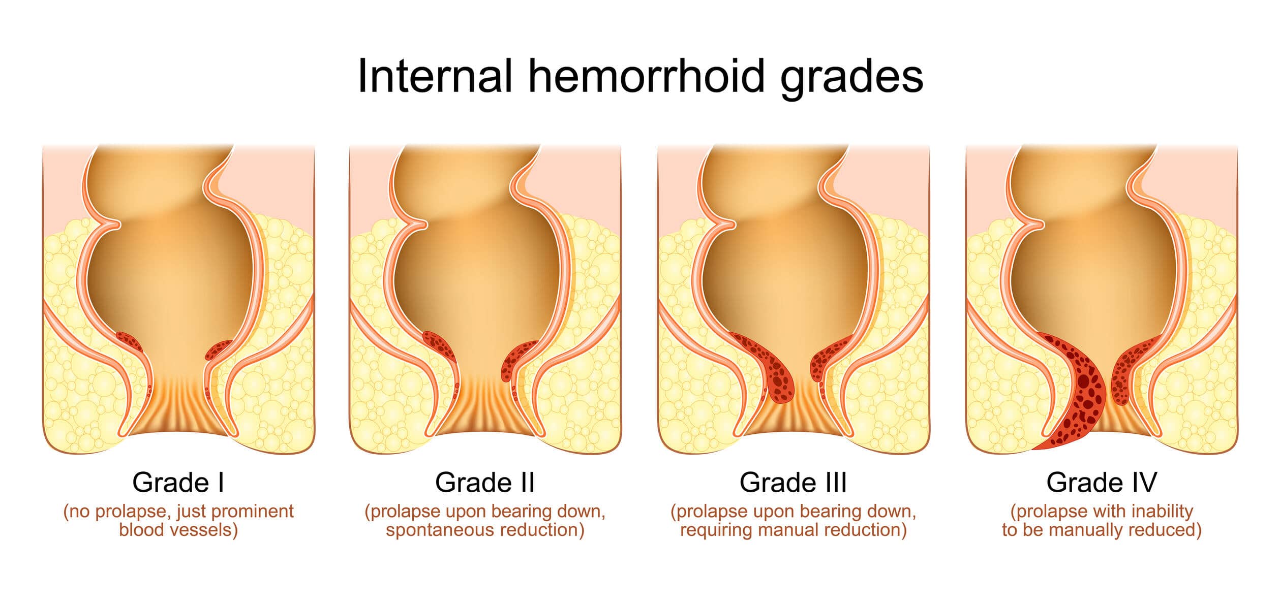 Prolapsed Hemorrhoid Vs External